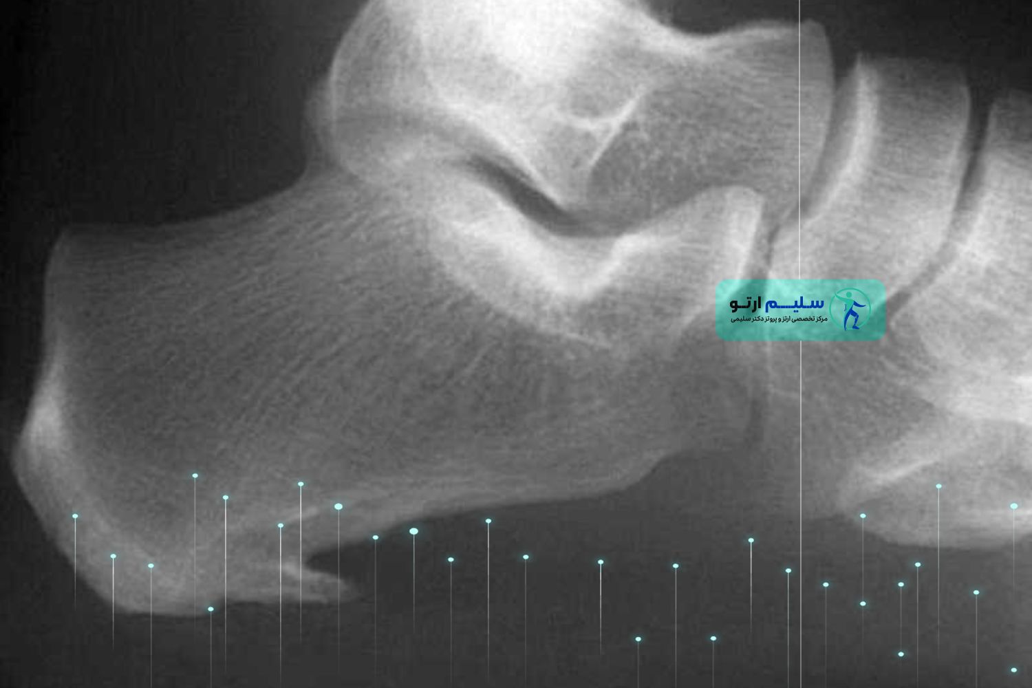 عکس خار پاشنه؛ مشاهده تصاویر واقعی و نمونههای پزشکی مرحله متوسط خار پاشنه