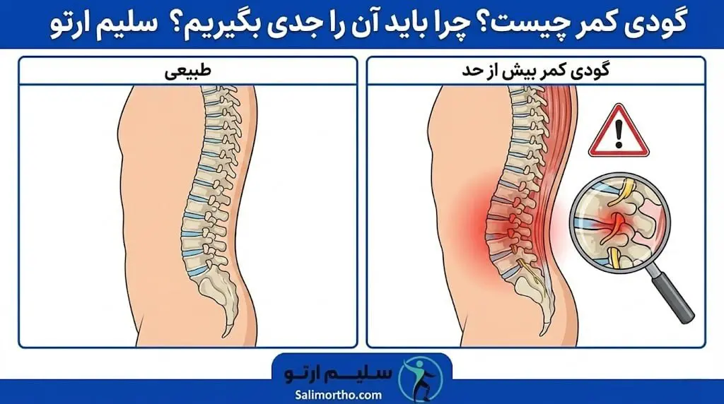 گودی کمر (لوردوز) چرا باید بیماری گودی کمر را جدی بگیریم؟